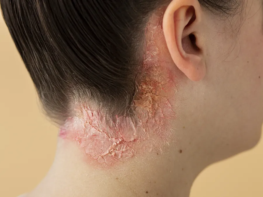 Skin & Allergies homeopathy treatment at Dr Raju's Homeopathy, Hyderabad